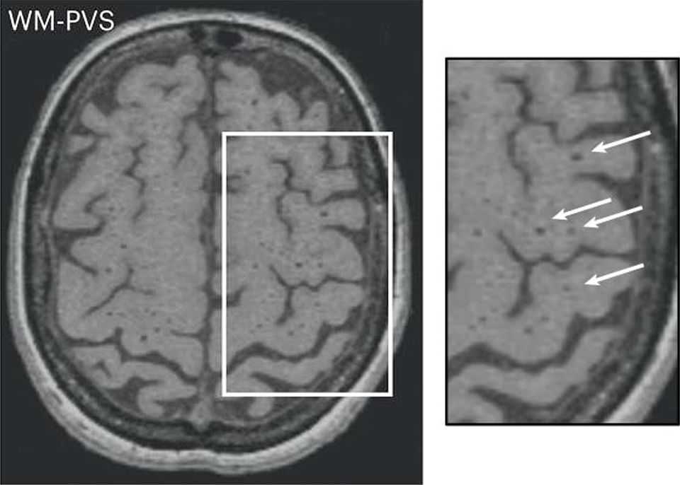 A large study reveals new mechanisms of cerebral small vessel disease