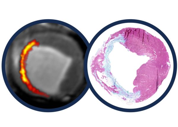 Photo : À gauche : une image IRM cardiaque obtenue avec la méthode SPOT. La zone colorée (jaune–rouge) correspond à la cicatrice myocardique détectée et quantifiée automatiquement le long de la paroi du ventricule.
À droite : une coupe histologique du myocarde (coloration tissulaire), où la cicatrice apparaît sous forme de tissu fibreux, clairement distinct du muscle sain.