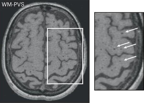 Photo : Brain MRI showing significant perivascular space loading in the white matter © Nature Medicine